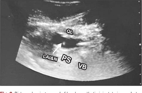 Figure 2 From Ultrasound Guided Transversalis Fascia Plane Block Versus Transmuscular Quadratus