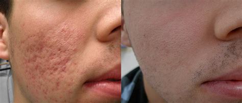 Fractional Laser Resurfacing 101: How It Works, Pros and Cons