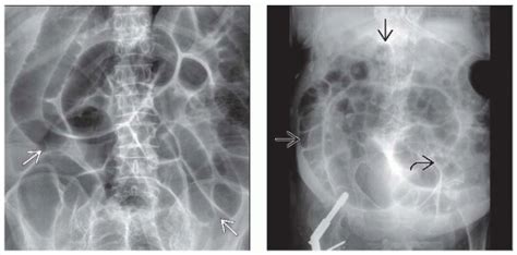 Ileus | Radiology Key