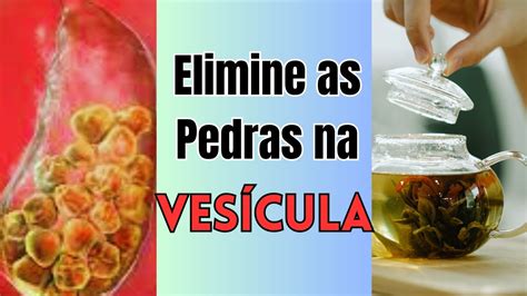 O Que É Bom Para Vesícula - Remedios Caseiro Para Pedra Na Vesícula - RETOEDU