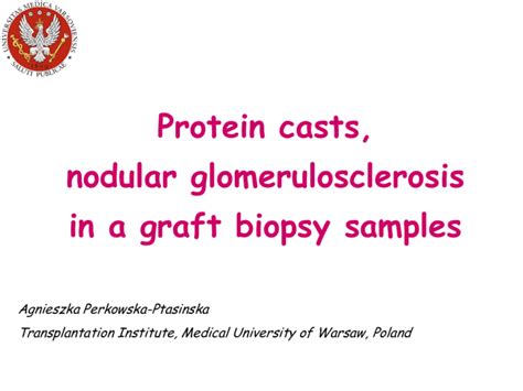 Protein Casts Nodular Glomerulosclerosis In Graft Biopsy