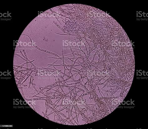 Microscopic Fungi Malassezia Furfur Showing Yeast Cells And Hyphae Dermatophytes Nail Scraping