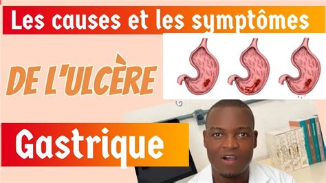 Causes Sympt Mes Et Traitement De L Ulc Re Gastrique Youtube