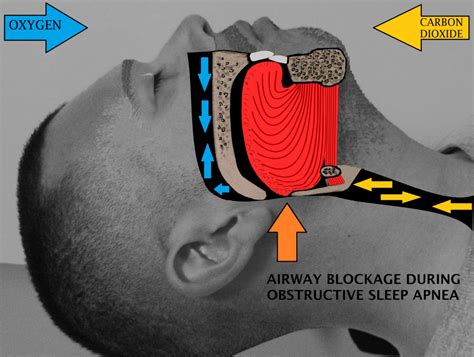 sleep surgery wikipedia