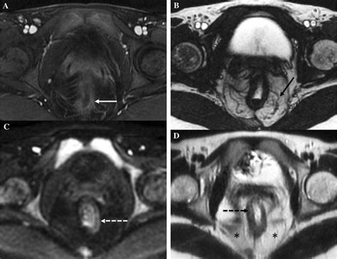 Proctitis Secondary To Ulcerative Colitis Axial Postcontrast T1 Download Scientific Diagram