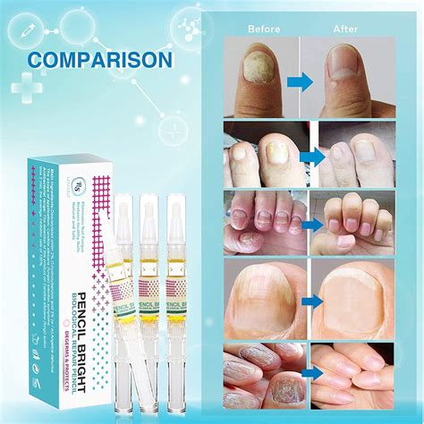 how to cure nail fungus quickly 5
