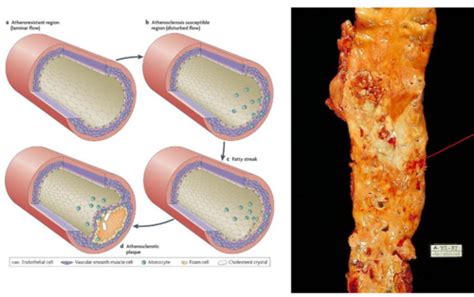 Atherosclerosis Flashcards Quizlet