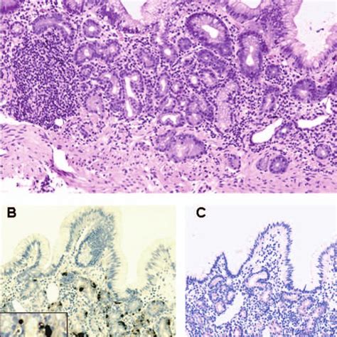 Helicobacter Pyloriassociated Atrophic Gastritis A Chronic Active