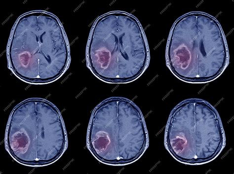 Premium Photo Ct Scan Brain Imaging For Hemorrhagic Stroke Or