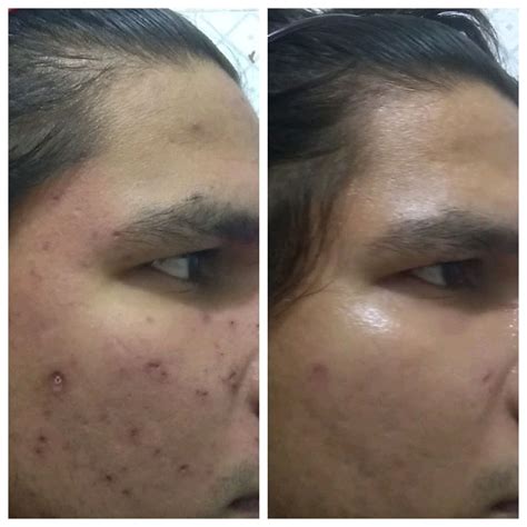 Chicken pox scars after excision.what next? - Scar treatments - Acne.org