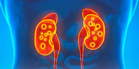 C Lculo Renal Conhe A Sintomas E Op Es De Tratamento