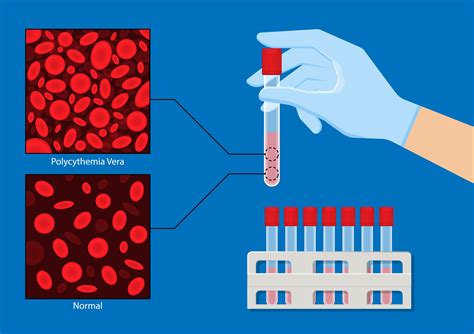 What Is Polycythemia Vera? - PV Reporter
