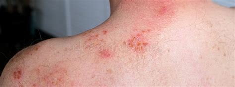 skin lesion symptom  shingles  herpes zoster  person viral