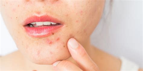 Everything You Need To Know About Cystic Acne Treatment Atelier Yuwa