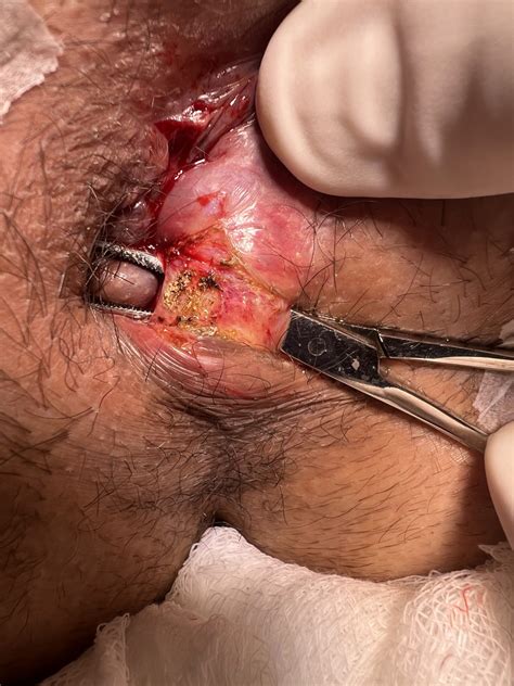 Fissura Anal Cr Nica Cirurgia Errada Feita Pelo M Dico Proctologista Dr Paulo Branco