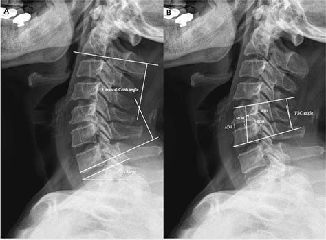 Illustrations Of Radiographic Measurements A Cervical Cobb Angle T1