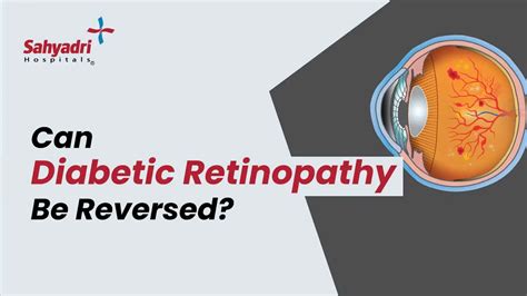 Can Diabetic Retinopathy Be Reversed Sahyadri Hospital