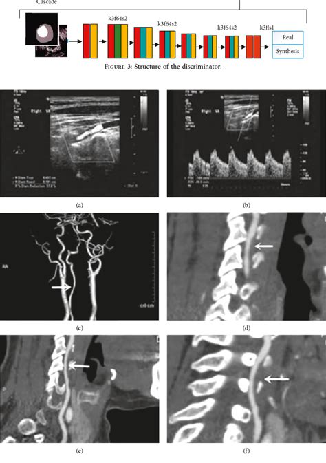 Figure From Study Of Vertebral Artery Dissection By Ultrasound Superb