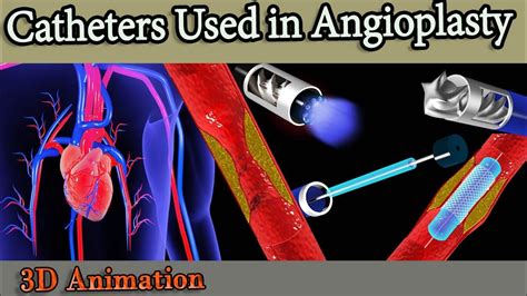 Different Types Of Catheters And Angioplasty What You Need To Know