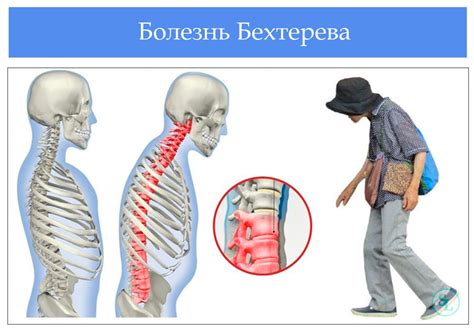 Коротко о аппарат бехтерева что такое