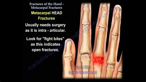 Metacarpal Fractures Everything You Need To Know Dr Nabil Ebraheim