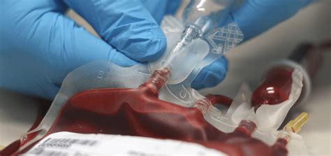 Blood Transfusion In Sickle Cell Disease Yoogy