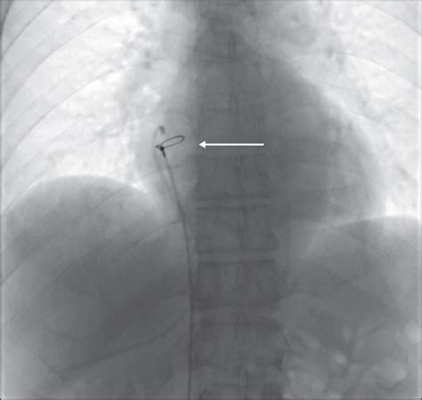 Jle Sang Thrombose Vaisseaux Extraction Percutan E De Cath Ter