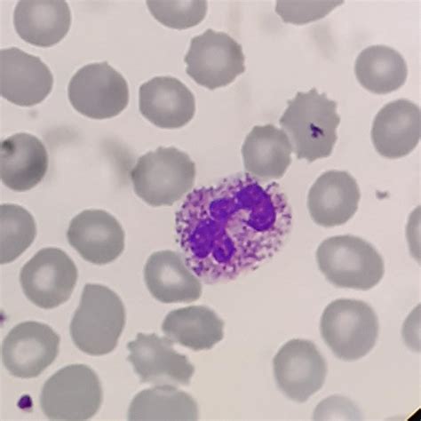 Moderado Número De Neutrófilos Hemácias Em Pequena Quantidade