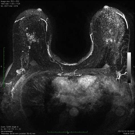 Figure From Mri In The Pre Operative Breast Cancer Staging Before