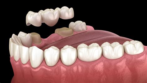 Dental Bridge Procedure - Dentalogos Oral and Dental Health Clinic