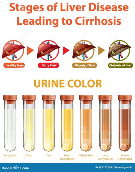 Estadios De Enfermedad Hep Tica Que Conducen A Cirrosis Ilustraci N Del
