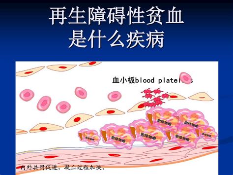 再生障碍性贫血是什么疾病gword文档在线阅读与下载免费文档