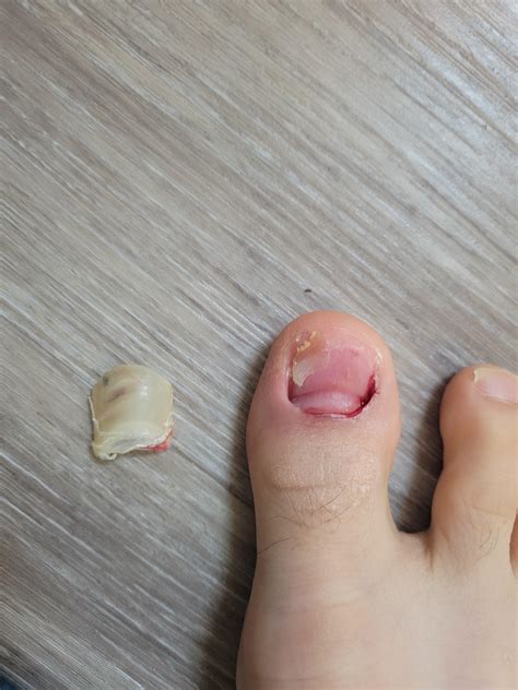 Big toe nail came off from playing basketball. What should I do? : r