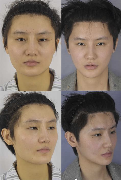 middle   facial feminization surgery  east asian transgender