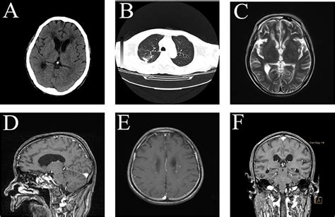 Frontiers Multifocal Brain Abscesses Caused By Invasive Streptococcus Intermedia A Case Report