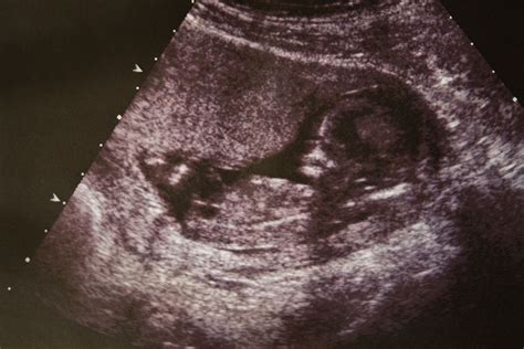 When Human Life Begins Is A Question Of Politics Not Biology Flaglerlive