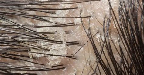 Normal Hair Part vs Thinning: Recognizing the Signs and Exploring ...