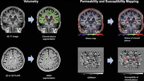 Choroid Plexus Volume And Permeability At Brain MRI Within The