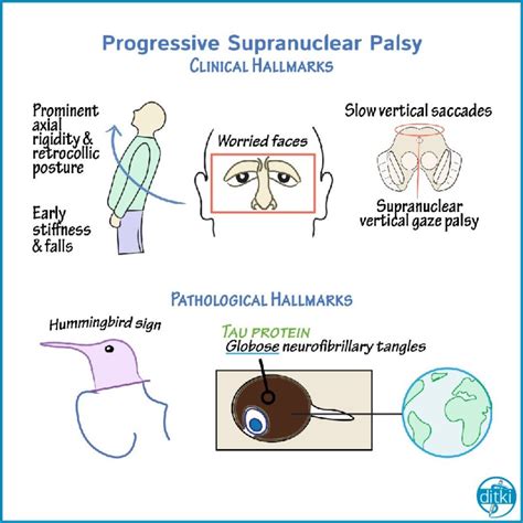 Review Clinical Hallmarks And Pathology Of Progressive Supranuclear Palsy Ditki Medicalscience