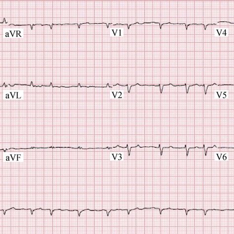 Electrocardiogram Showing Atrial Fibrillation With Rapid Ventricular