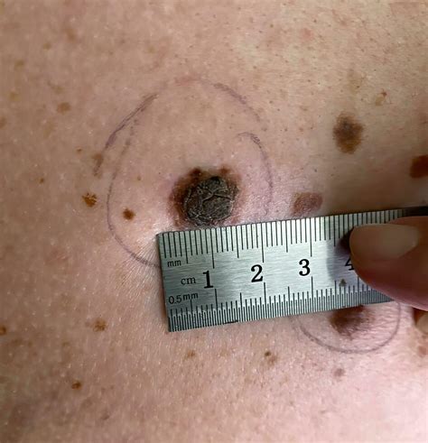 Wart Removal Stock Photos Images And Backgrounds For Free Download
