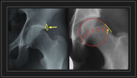 Choque Femoroacetabular Dr Ngel Torres