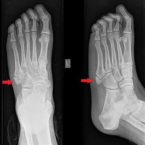 Plain Radiograph Ap And Lateral Oblique Of The Left Foot Injured