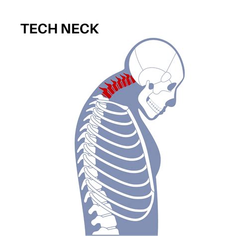 #DidYouKnow?Is “Tech Neck” Wreaking Havoc on Your Health? 📱💻📺
