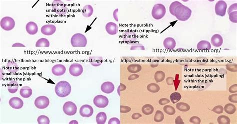 Haematology In A Nutshell Basophilic Stippling