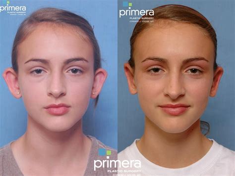 Ear Surgery Otoplasty Before And After Pictures Case 111 Orlando