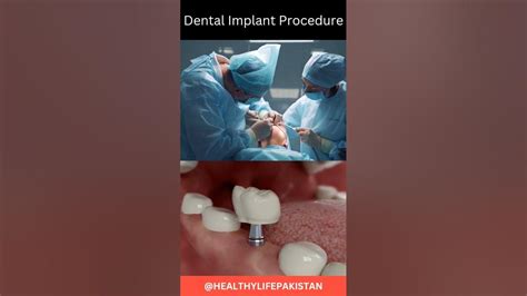 Dental Implant Procedure Youtube