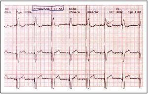 Los Marcapasos Card Acos Medicina Integral