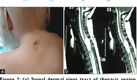 Dermal Sinus Tract