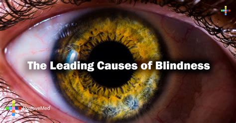 The Leading Causes Of Blindness PositiveMed